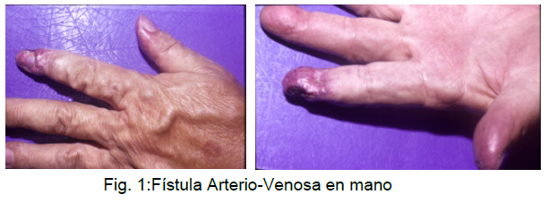 Fistula