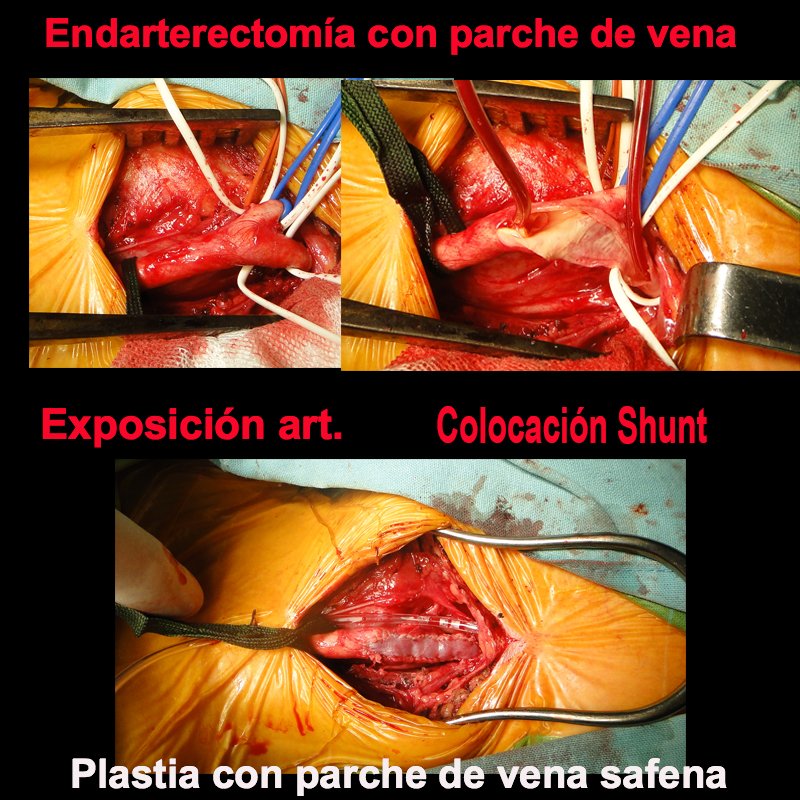 Parche de vena