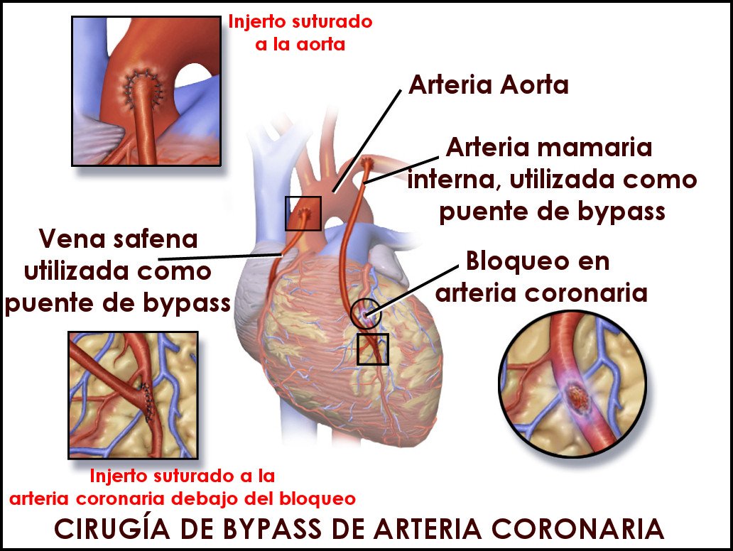 bypass coronario